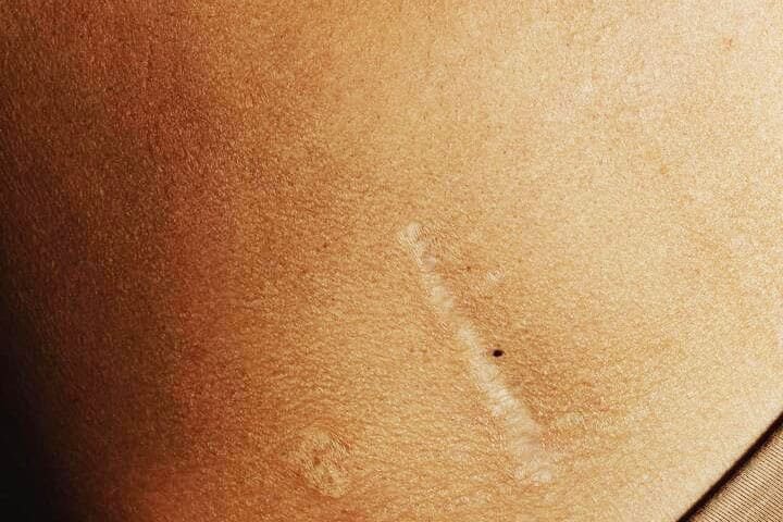 Foto de uma pele de pessoa com duas cicatrizes. A foto ilustra o artigo Por que desconstruir os seus padrões comportamentais por meio da sua aceitação e da sua transformação escrito pelo psicanalista Homero Mônaco para o site Online Psicanalista. Foto de uma menina com perna levantada como se fosse pisar na lente da câmera que a fotografa. A foto ilustra o artigo 10 Maneiras Como a Terapia Psicanalítica Ajuda na Cura de Feridas Emocionais escrito pelo psicanalista Homero Mônaco para o site Online Psicanalista.